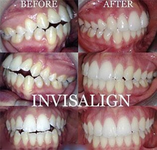 Click to enlarge image invisalign-3.jpg